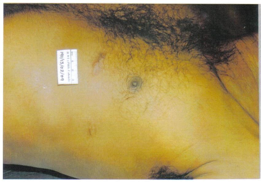 2. Shiny brownish scar, 2cm x1cm horizontally place in anterior axillary line lateral to scar No.1 (Fig -1). 3. Shiny brownish raised scar, 3cm x 1.