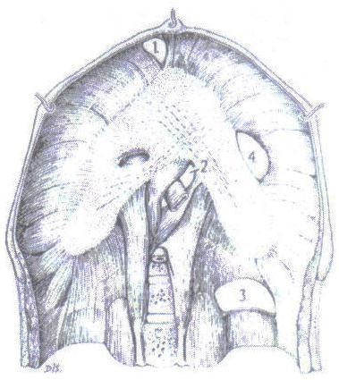 Fig. 3 Herniation of Stomach, Colon and Omentum into the left chest cavity with adhesions and exudates Fig. 4 Hiatus in the left side of the diaphragm Fig.