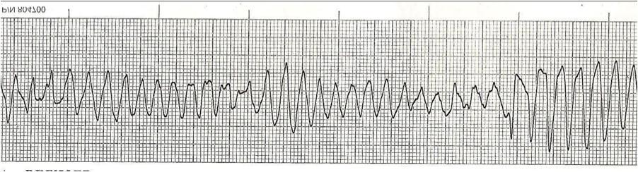 67-year-old woman Diagnosed with pneumonia after mitral valve repair Developed the following on electrocardiogram.