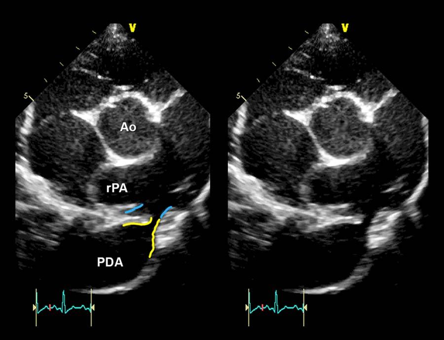 (C) transthoracic echocardiographic image from the left (TTE-L), (D) transesophageal echocardiographic image in 2D (TEE-2D), (E,F) transesophageal echocardiographic image in 3D (TEE-3D) with