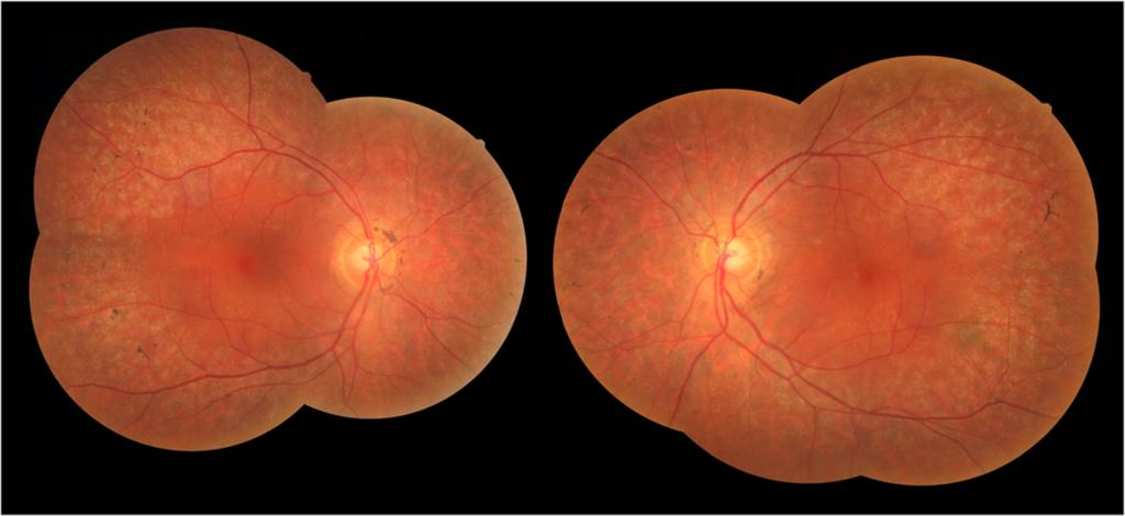 Enzsoly et al. BMC Ophthalmology Page 2 of 5 Figure 1 Composit fundus photography.