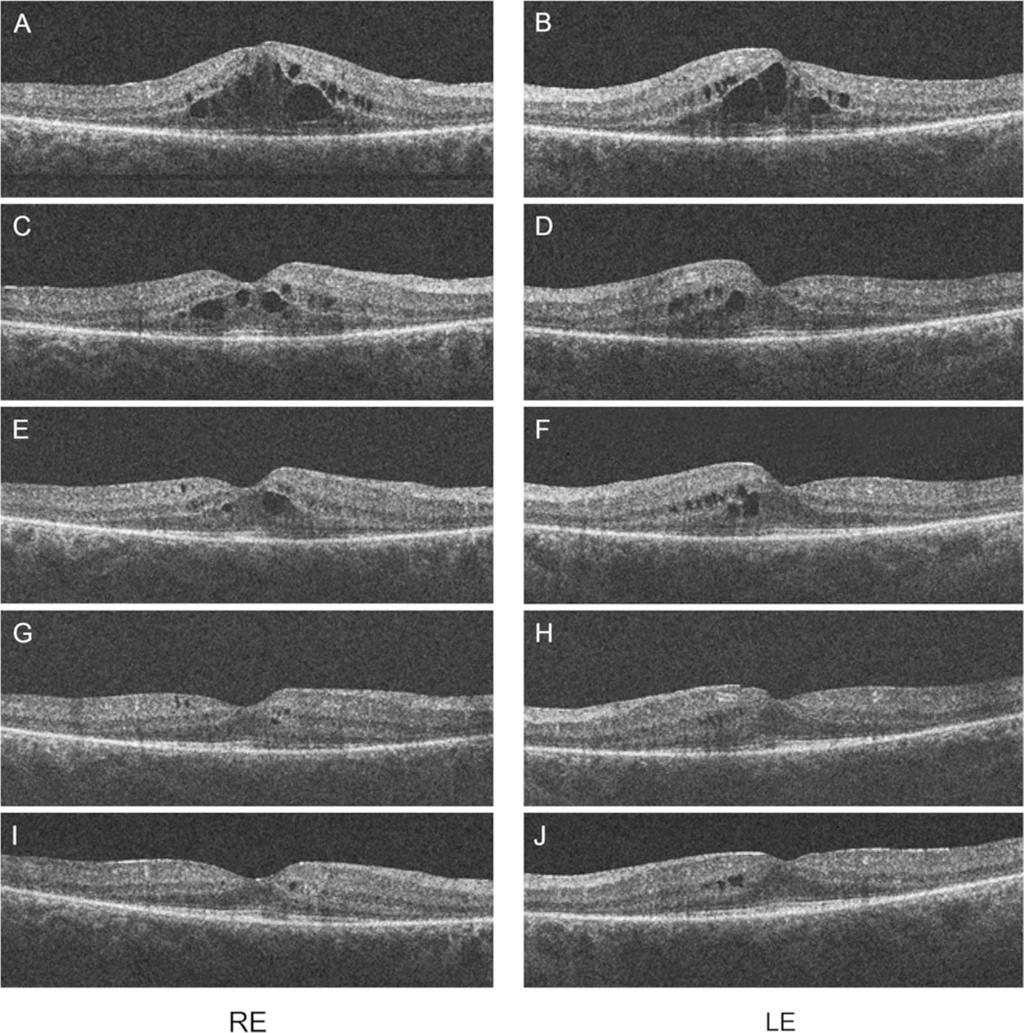 Enzsoly et al. BMC Ophthalmology Page 3 of 5 Figure 2 OCT scans of the macula of both eyes after 4 series of TAC treatment (A, B).