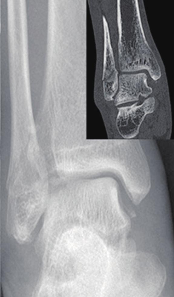 Osteoporotic Fracture: 2015 Position Statement A B C D E F Fig. 3. Typical osteoporotic fractures at minor sites.