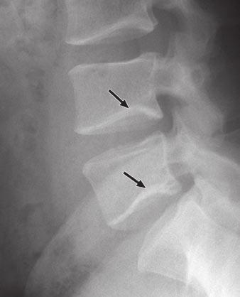 Role of Radiologists in Osteoporosis in Women Fig. 6 55-year-old woman with Cupid s bow normal variant. Lumbar spine radiographs show Cupid s bow normal variant in lower lumbar spine.
