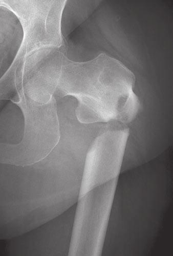 The Genant semiquantitative method is the current technique of choice in identifying osteoporotic vertebral fractures with DXA (as well as radiographs).
