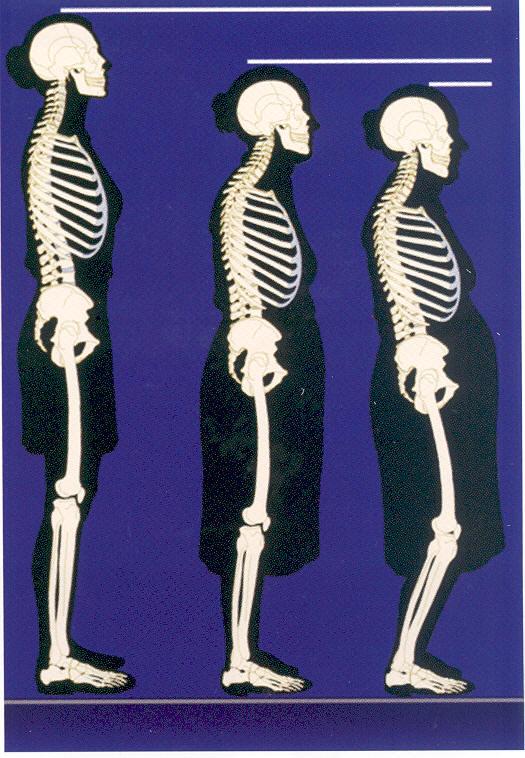 Elderly with osteoporosis.