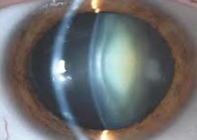RK Incisions Can Rupture During Surgery Very Small Optical Zones With Irregular Astigmatism Can Have Severe Dry