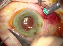 CATARACT AND RETINAL SURGERY COMBINED APPROACH ADVANTAGES POST VITRECTOMY