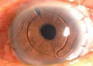 FEMTO CATARACT SURGERY A) I am not currently working with surgeons