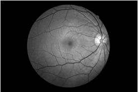 Ocular History: LASIK? Contact lens? Glaucoma? Macular disease? Vitrectomy? Strabismus? Uveitis?