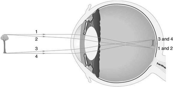The Optical System of the Eye Monofocal Lens Implant Mono-focal = single focal