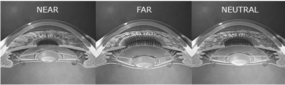 Implant Accommodation = movement of the lens to improve near vision Crystalens