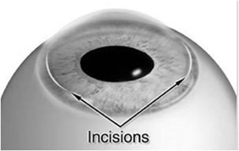 Limbal Relaxing Incisions Surgical incisions on the cornea Alternative to toric IOL for