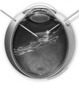 Post-Vitrectomy Unstable lens position during surgery Capsular
