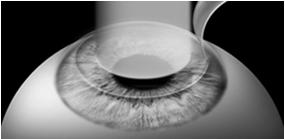 > 26 mm Refractive surgery RGP lens wear Difficulty targeting IOL