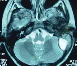 ing scan with contrast applied in venous sinuses. Obstruction to the blood flow through the lateral sinus, and lateral sinus thrombosis, is prominent on the left side.