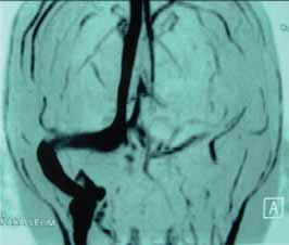 With regard to clinical profile and associated intracranial and intratemporal complications the indication for the operation was established.