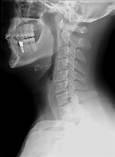 CASE PRESENTATION #4 Supraglottitis affects more than just the