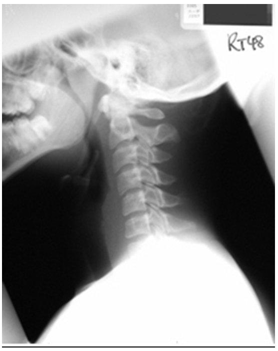 Syndrome Eagle Syndrome Panoramic Radiograph Eagle -Barrett Syndrome Complications of Eagle