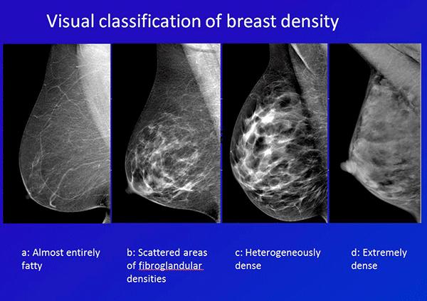 BREAST HEALTH BREAST DENSITY Currently, 34 states require some type of notification after a mammogram where dense breasts are diagnosed.