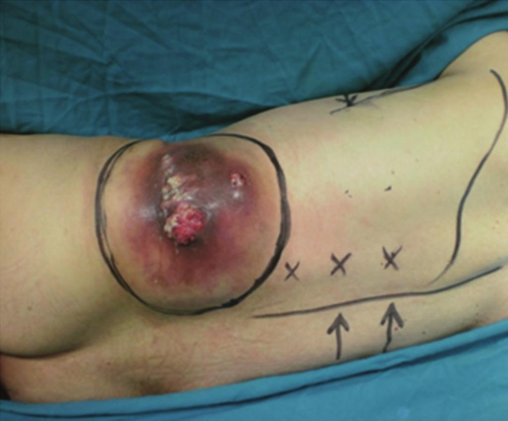 2 Case Reports in Surgery Figure 1: An infected recurrence on the lobotomy scar. Figure 3: The specimen with the distal 11th rib (arrow). Figure 2: Left lumbar mass invading the iliopsoas muscle.