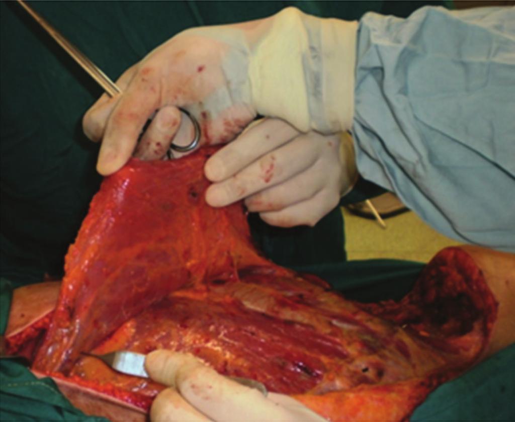 The LD has a double vascularization as described by Mathes and Nahai [10] and if it remains one of the most used flaps in plastic surgery, its reverse version is not so common.