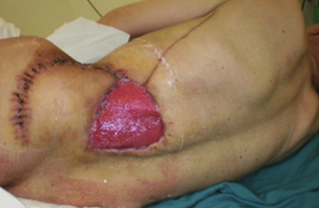4 Case Reports in Surgery (a) (b) Figure 9: (a) Granulating wound, (b) skin graft. Figure 10: Local result after 8 months. 4.