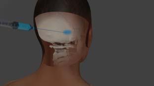 Face Restlessness or Agitation CLUSTER HEADACHE Vascular dilation Trigeminal nerve stimulation Histamine release Circadian rhythm disturbances