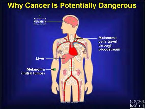 90% of cancer deaths are due to metastases Liver with pancreatic cancer metastases If
