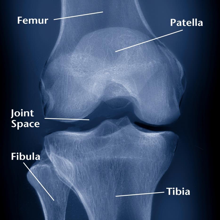 Knee X-Rays Healthy