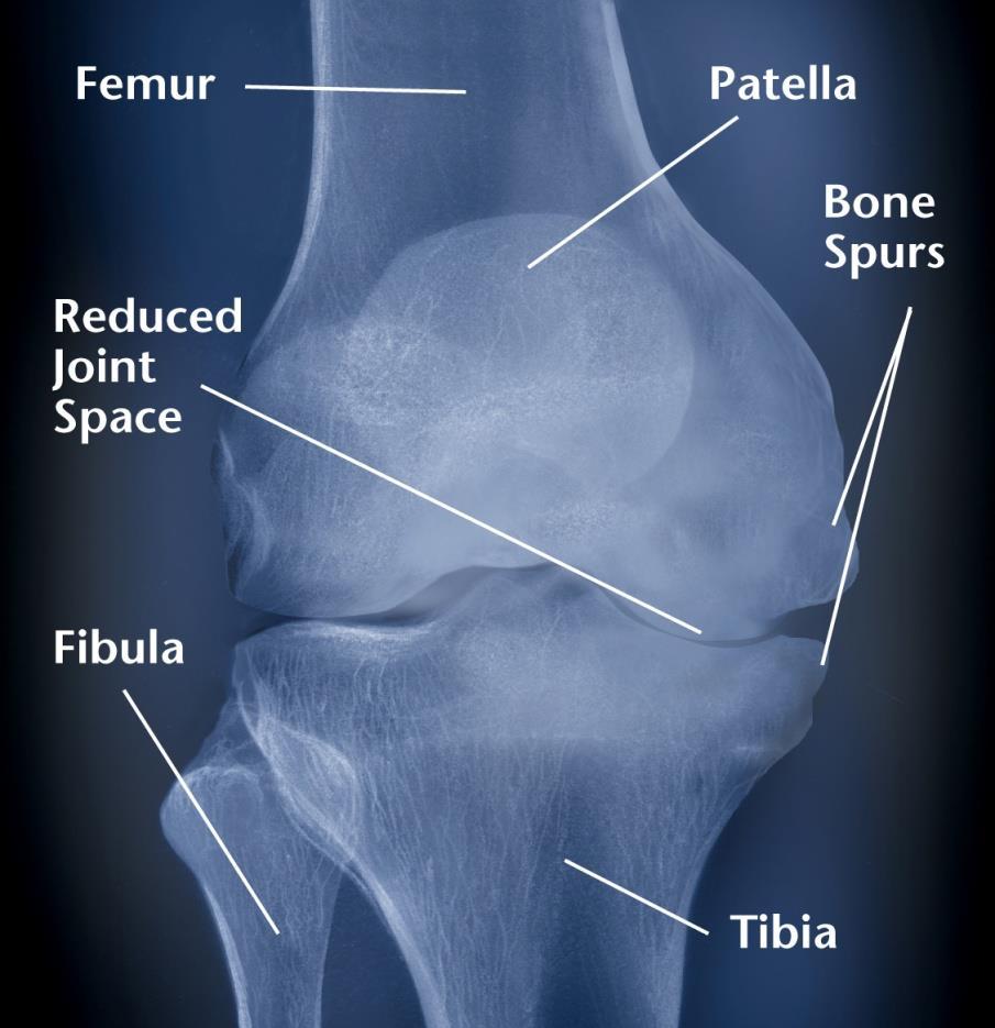 Knee Joint Pfizer