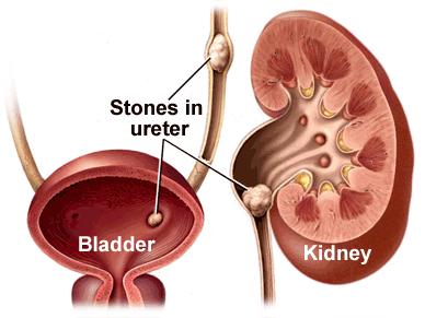 Urinary tract obstruction syndrome urinary tract obstruction can occur at any point in the urinary tract, from the kidneys to the urethral meatus it can develop secondary to calculi, tumors,