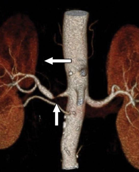 Hypertensive syndrome 1 elevated > 140/90 mm Hg blood pressure (renal or renovascular hypertension), caused by a narrowing in the arteries that deliver blood to the kidney (renal artery stenosis)
