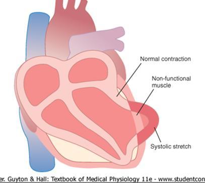 D.Causes of Death following Infarction Decreased Cardiac Output Overall pumping strength of the infarcted heart is often decreased more than expected because of systolic stretch=instead of