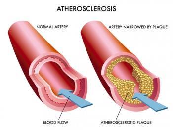 How? 1. Large quantities of cholesterol gradually become deposited beneath the endothelium at many points in arteries throughout the body (cholesterol plaques). 2.