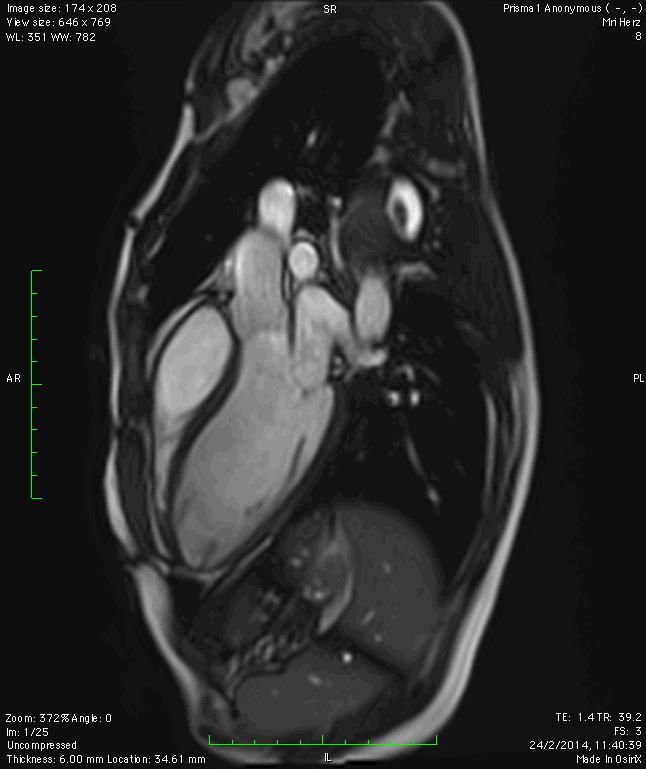 The Value of Stress MRI in Evaluation of Myocardial Ischemia Dr.