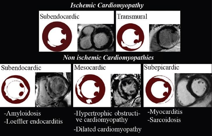 Olivas-Chacon et al, Magnetic Resonance Imaging of Non-ischemic Cardiomyopathies: A