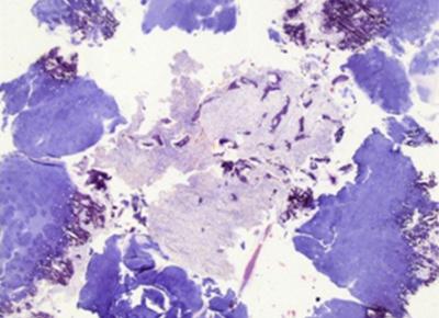 Figure 4 Figure 4: Islands of Fibrous Dysplasia surrounded by nodules of benign hyaline cartilage with focal enchondral ossification (H&E, 100X).