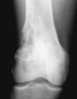 If sections include the interface of the lesion with normal bone, fibrous tissue within Haversian canals or between mature cancellous trabeculae is a telltale sign of malignancy.