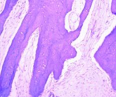 D, lthough the fibrous tissue between the bone spicules is bland, there is no marrow evident.