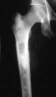 and C, Pain in the left leg resulted in radiographs demonstrating multiple disparate osteosclerotic lesions of the femur.