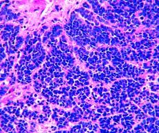 Their round or ovoid enlarged nuclei may contain 1 or more prominent nucleoli, and the tumor cells may even appear as cohesive as in some poorly differentiated carcinomas.