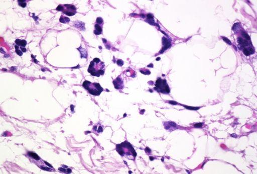 Spindle cell