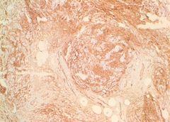 Mammary-type fibroblastoma Desmin+ CD34