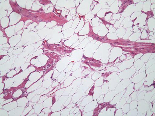 Myolipoma of sos Bssue Benign tumor