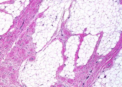 Lipoblastoma Lobules of