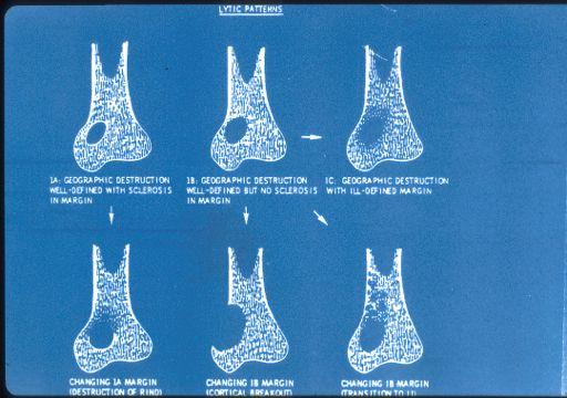 Radiologic Patterns Sclerotic margin is generally an indication of benign, slowlygrowing