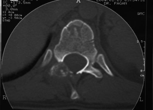 3cm Osteoblastoma