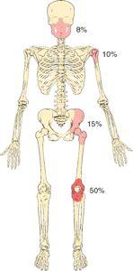 Osteosarcoma Metaphysis of long bones Femur, tibia, humerus (56%);