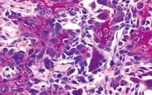 by tumor cells 35% of all sarcomas -
